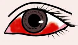 結膜下出血(>_<)