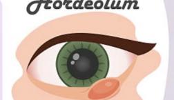 ものもらい（麦粒腫）